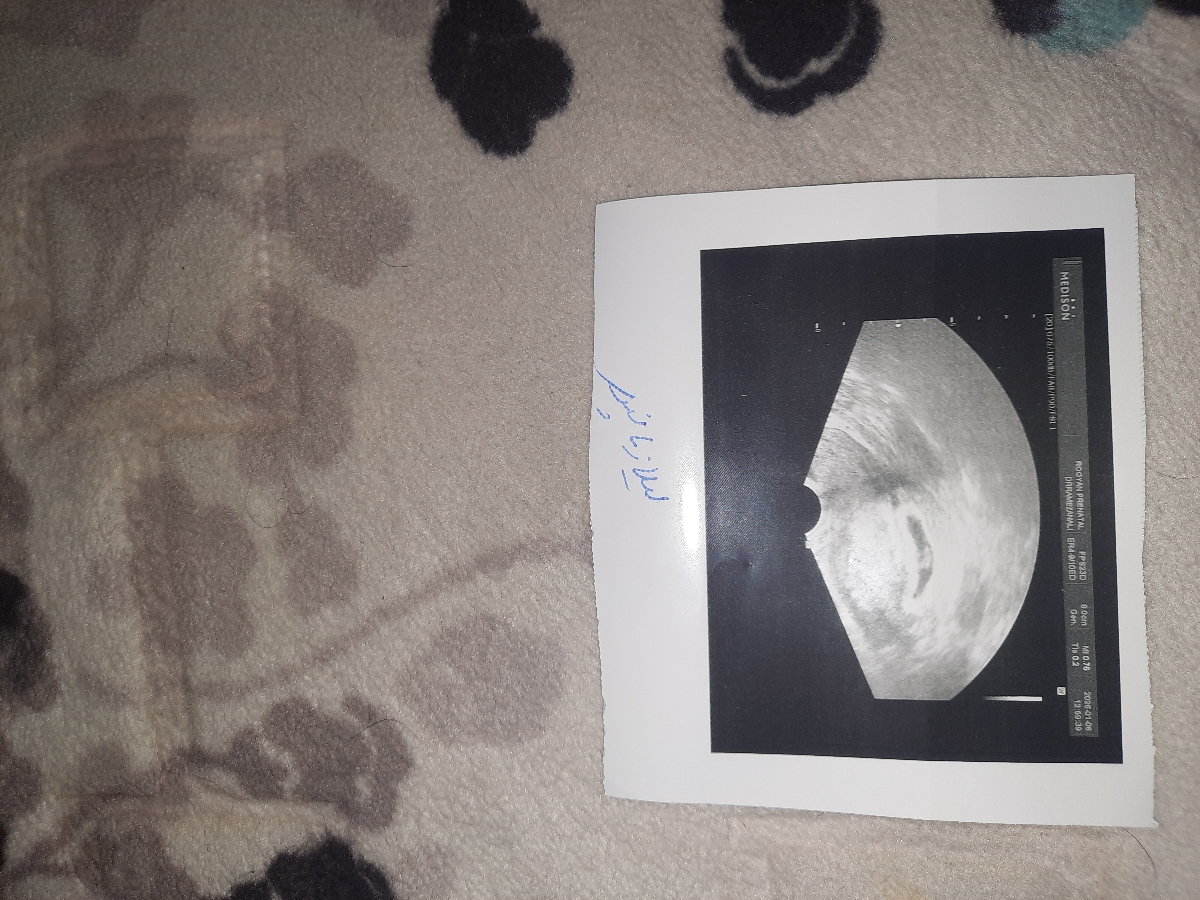 سلام خوبی مریم جون 
این سونوگرافی من نگاه کنید اون جنین داخل هست عزیزم 
قلب جنین تشکیل شده بود عزیزم 
من آمپول انوکسا پارین دورنافی میزنم آمپول پروژسترون میزنم آسپرین میخوردم فولیک اسید۵ قرص هیدروکسی کلروکین قرص پردنیزولون ۵