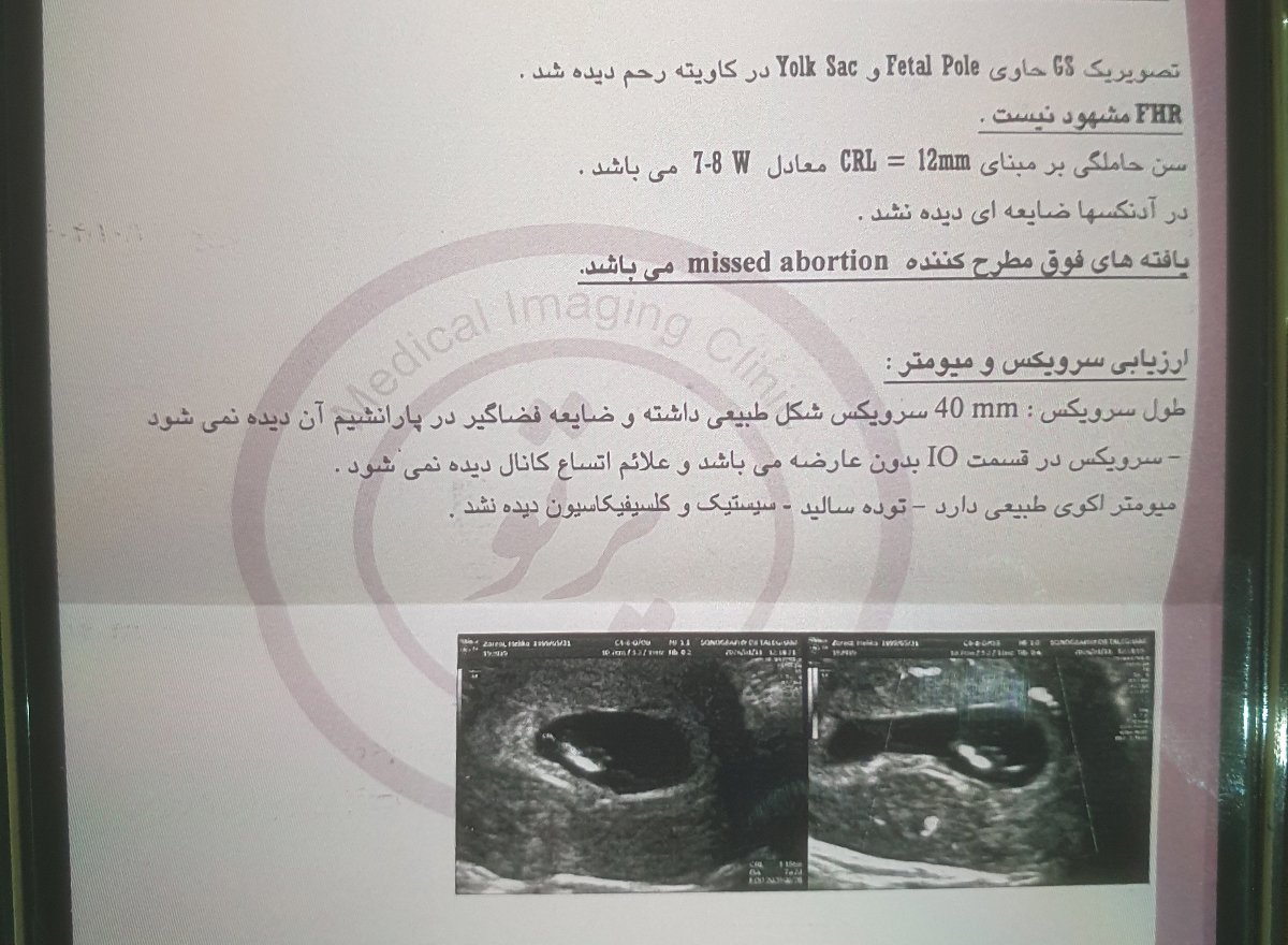 قلب جنین ۸ هفته