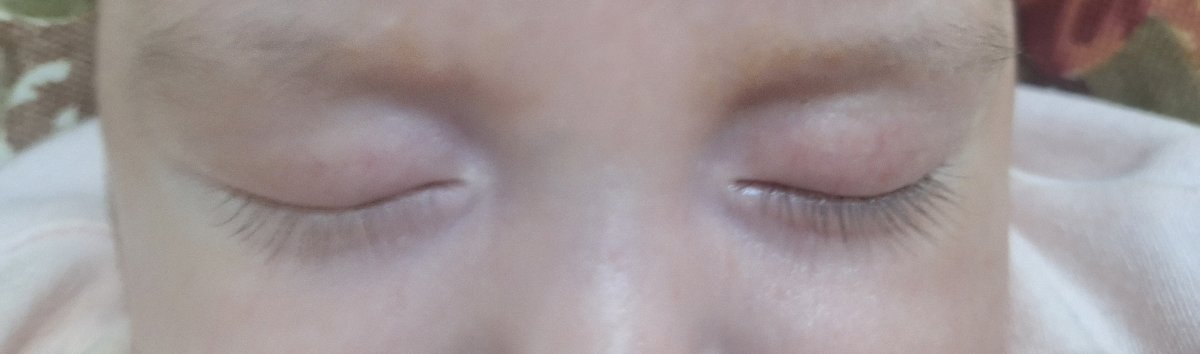 سلام، نوزاد من ۳ ماهشه، یکی از چشماش مژه اش مشکیه اون یکی بوره