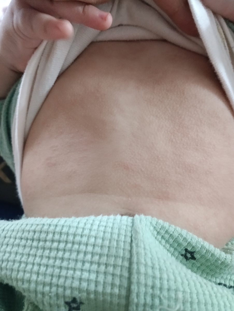 دلیل دانه زدن شکم و پشت بچه بعد از تب چیه؟