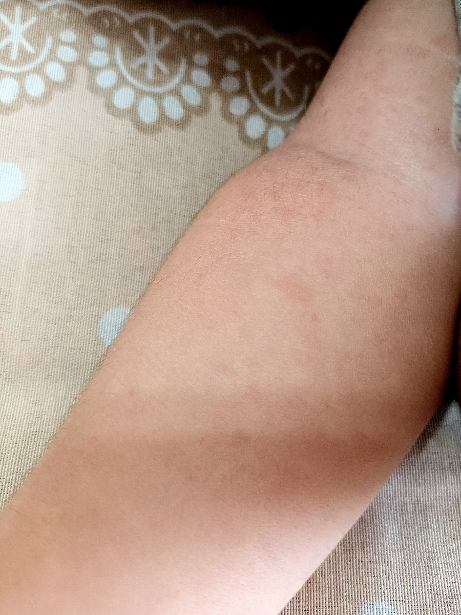 دلیل دانه زدن شکم و پشت بچه بعد از تب چیه؟