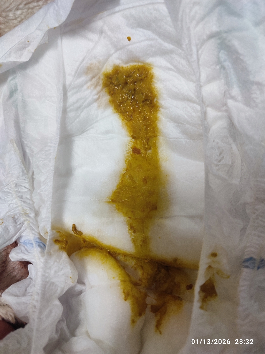 دکترجان خیلی خیلی شرمنده و عذر میخوام بابت عکس 🫠 این نوع مدفوع طبیعیه ؟ از اول اینجور بود . تو تاپیکها دیدم مدفوع مخاطی و اینا میگن بده این مخاطی نیست که هست ؟
بعد کنار ناخنهای دخترم هم پوست پوست شده . نه مثل پوسته ریزی بدن نوزاد ، مثل موقعی که خودم باردار بودم کنار ناخنهام پوست مینداخت از دو طرف دکترجان خیلی خیلی شرمنده و عذر میخوام بابت عکس 🫠 این نوع مدفوع طبیعیه ؟ از اول اینجور بود . تو تاپیکها دیدم مدفوع مخاطی و اینا میگن بده این مخاطی نیست که هست ؟
بعد کنار ناخنهای دخترم هم پوست پوست شده . نه مثل پوسته ریزی بدن نوزاد ، مثل موقعی که خودم باردار بودم کنار ناخنهام پوست مینداخت از دو طرف