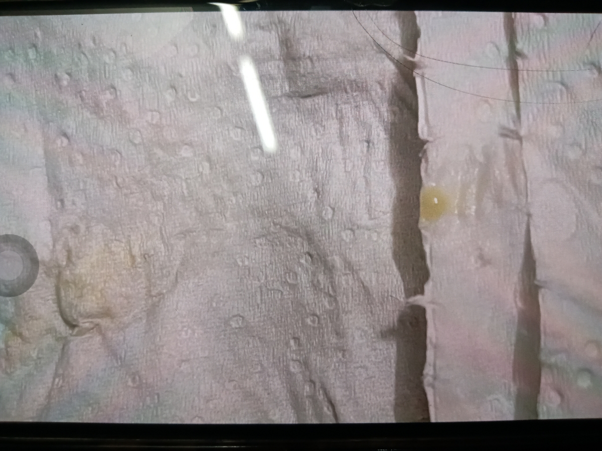 ترشح سبز رنگ در بارداری