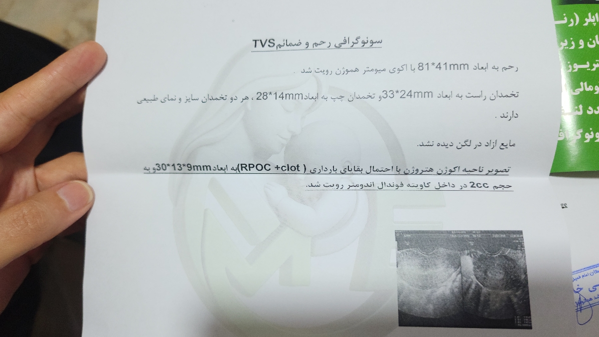 ساک حاملگی بدون جنین