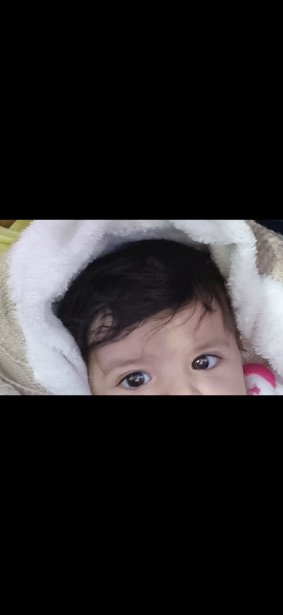 تشخیص انحراف چشم در نوزاد ۴ ماهه