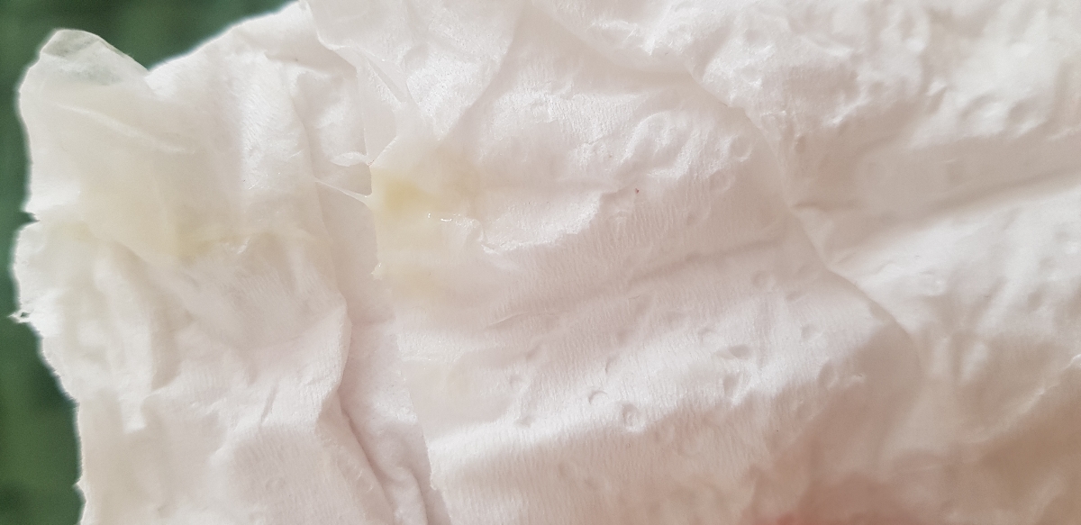 ترشح سبز و کمی خارش