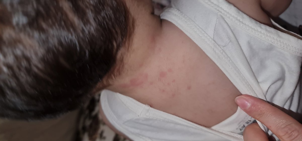 دانه های پوستی متعدد روی بدن نوزاد یکساله