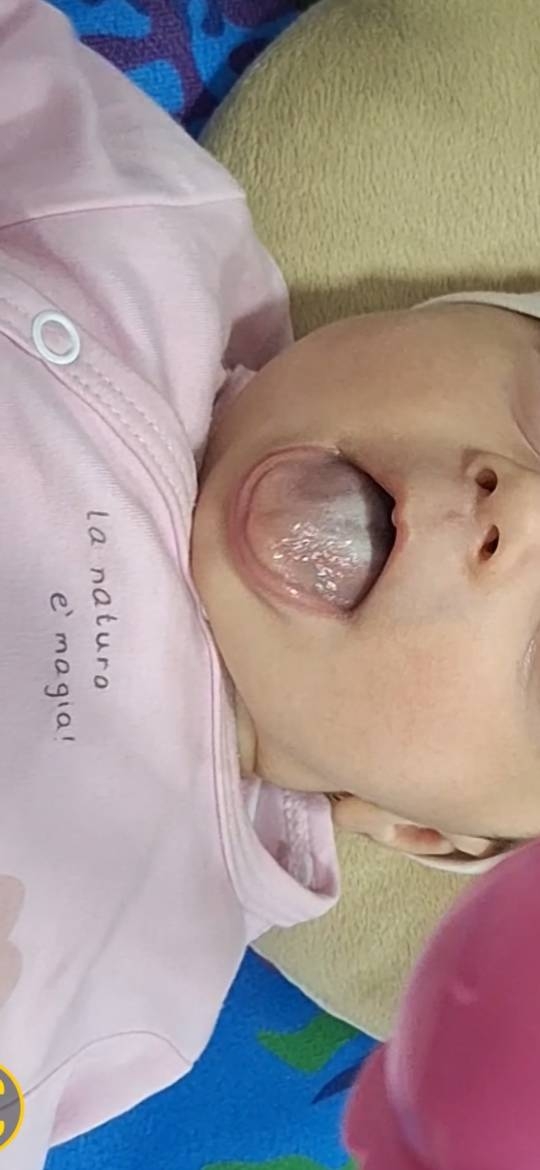 سفیدی زبان نوزاد دو ماهه