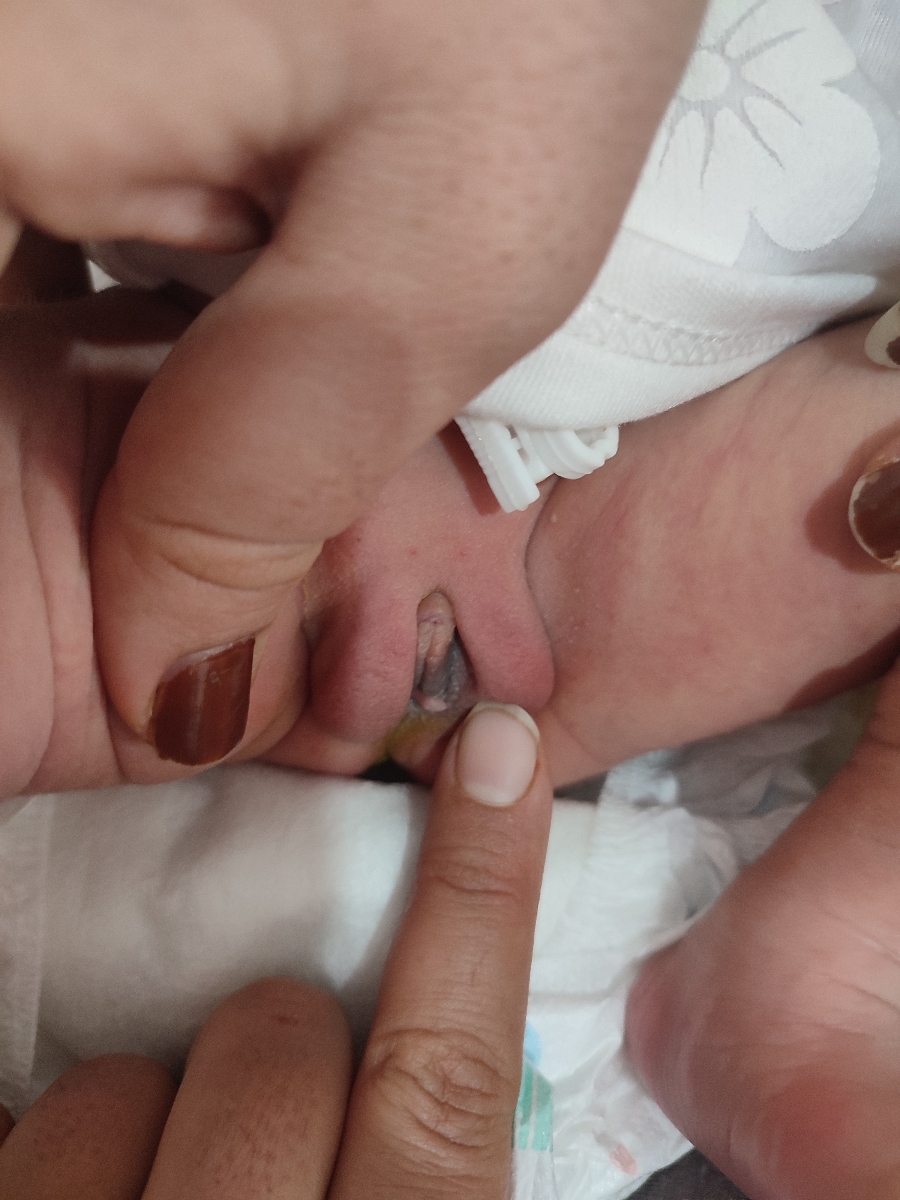 لابیا نوزاد کبود