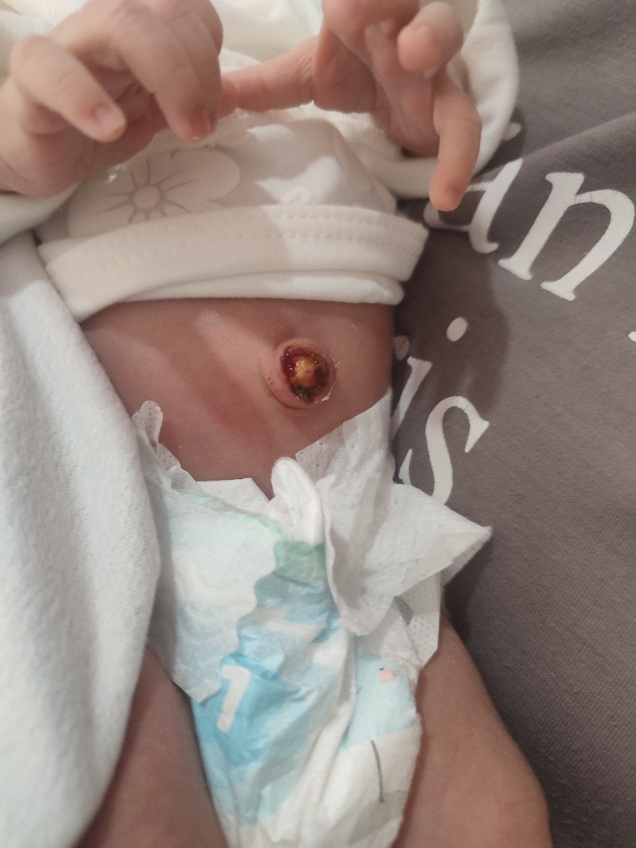 بند ناف ،خشک ،نوازده ،ده روزه