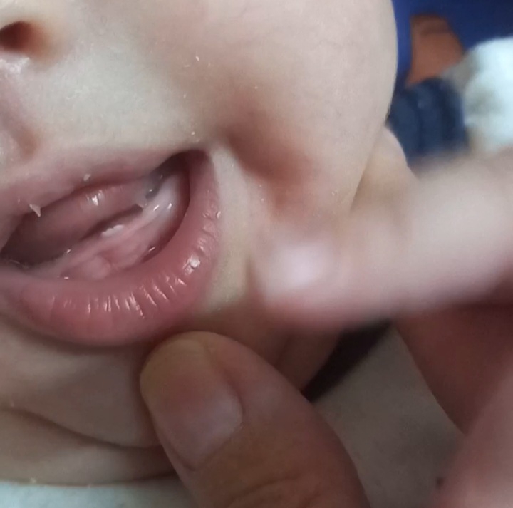 تشخیص رفلاکس نوزاد و قطره دایمتیکون تشخیص رفلاکس نوزاد و قطره دایمتیکون