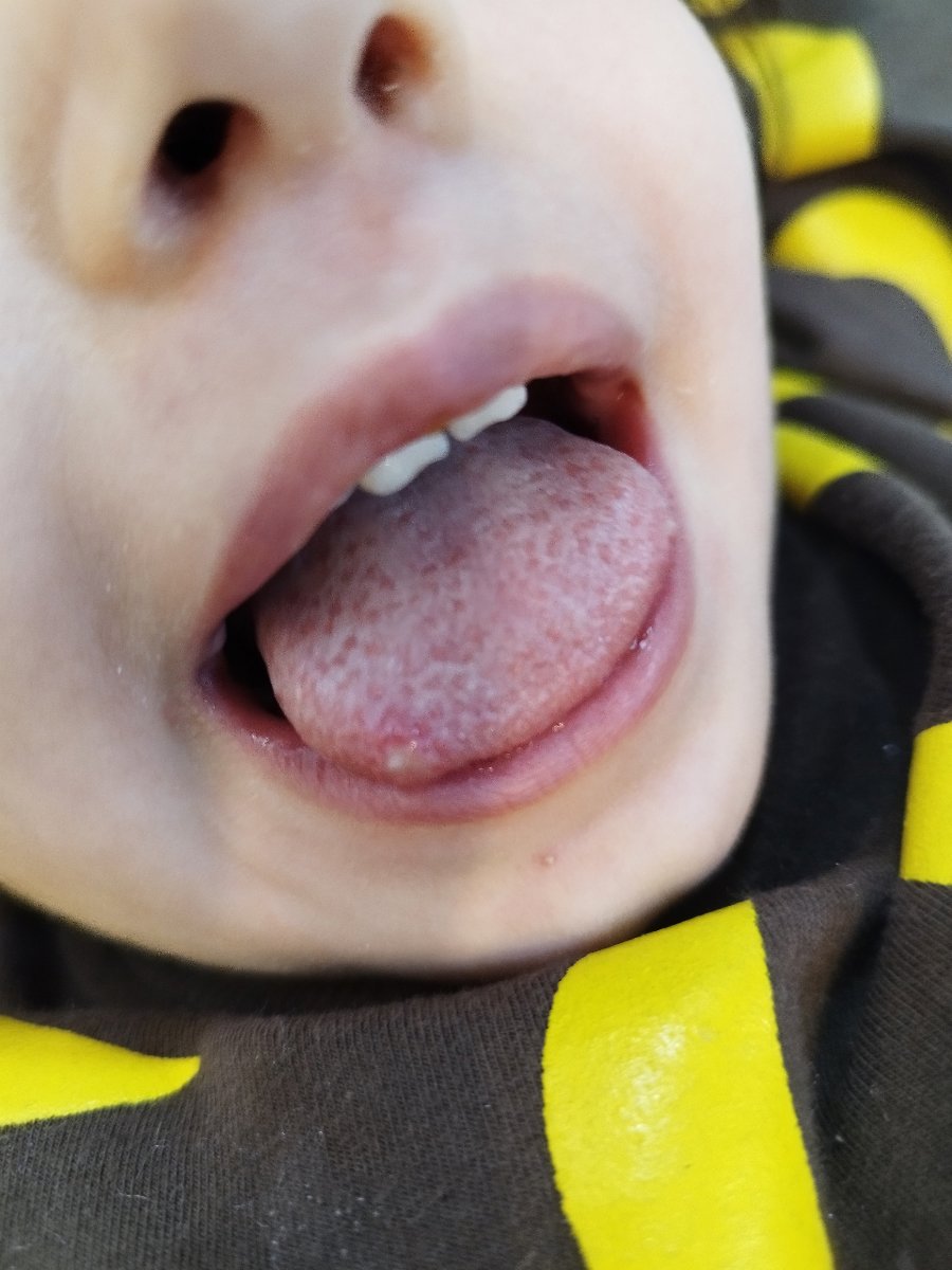 گوشه زبونش
چندتا جوش ریز هم روی‌ چونه و اطراف لبش