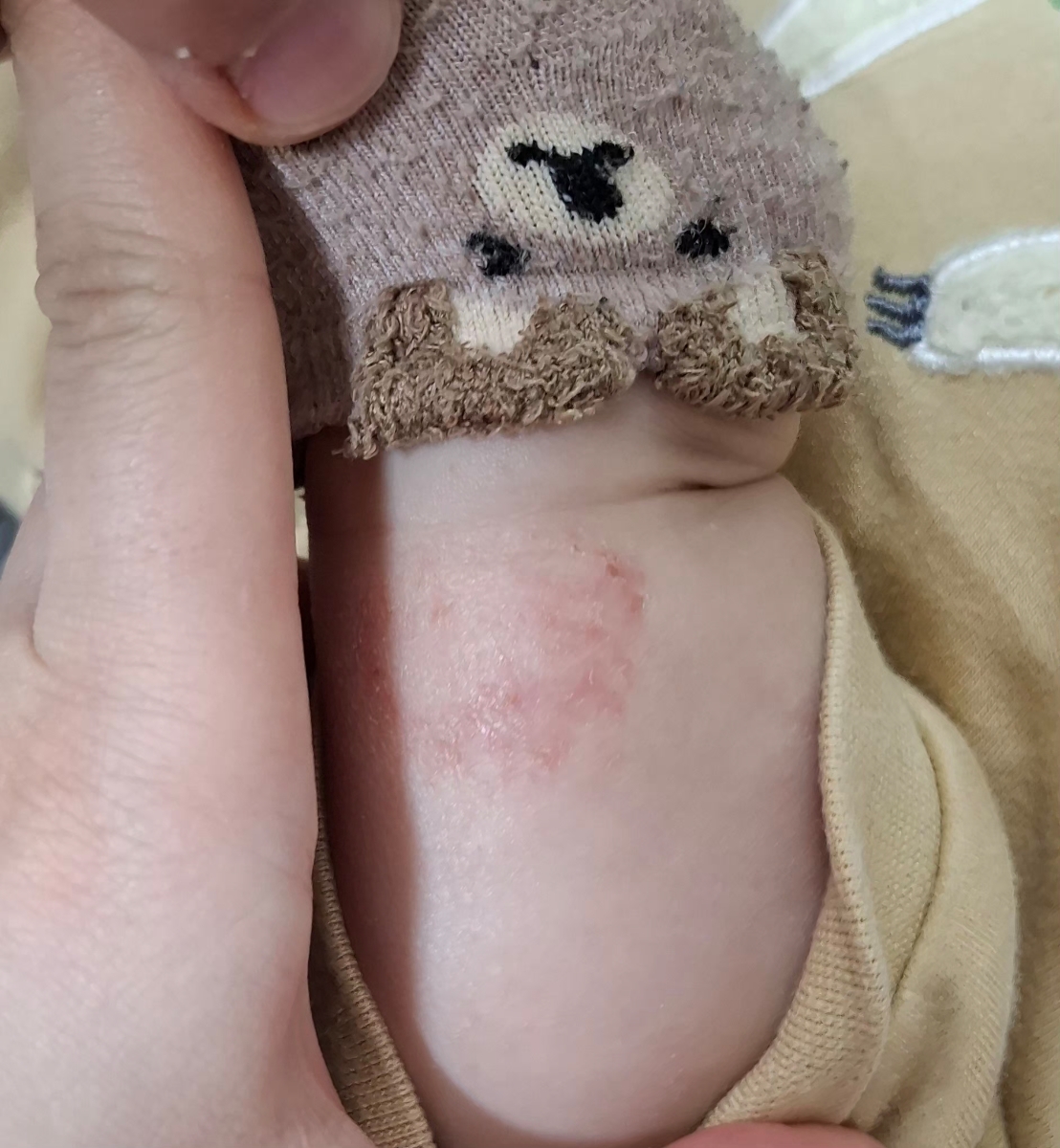 زخم پای نوزاد همراه عکس