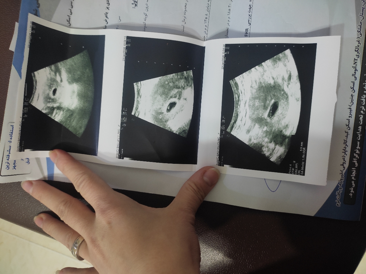 لکه بینی و احتمال سقط