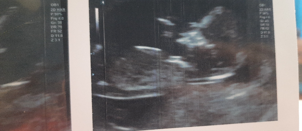 تعیین جنسیت جنین با سونو ان تی تعیین جنسیت جنین با سونو ان تی