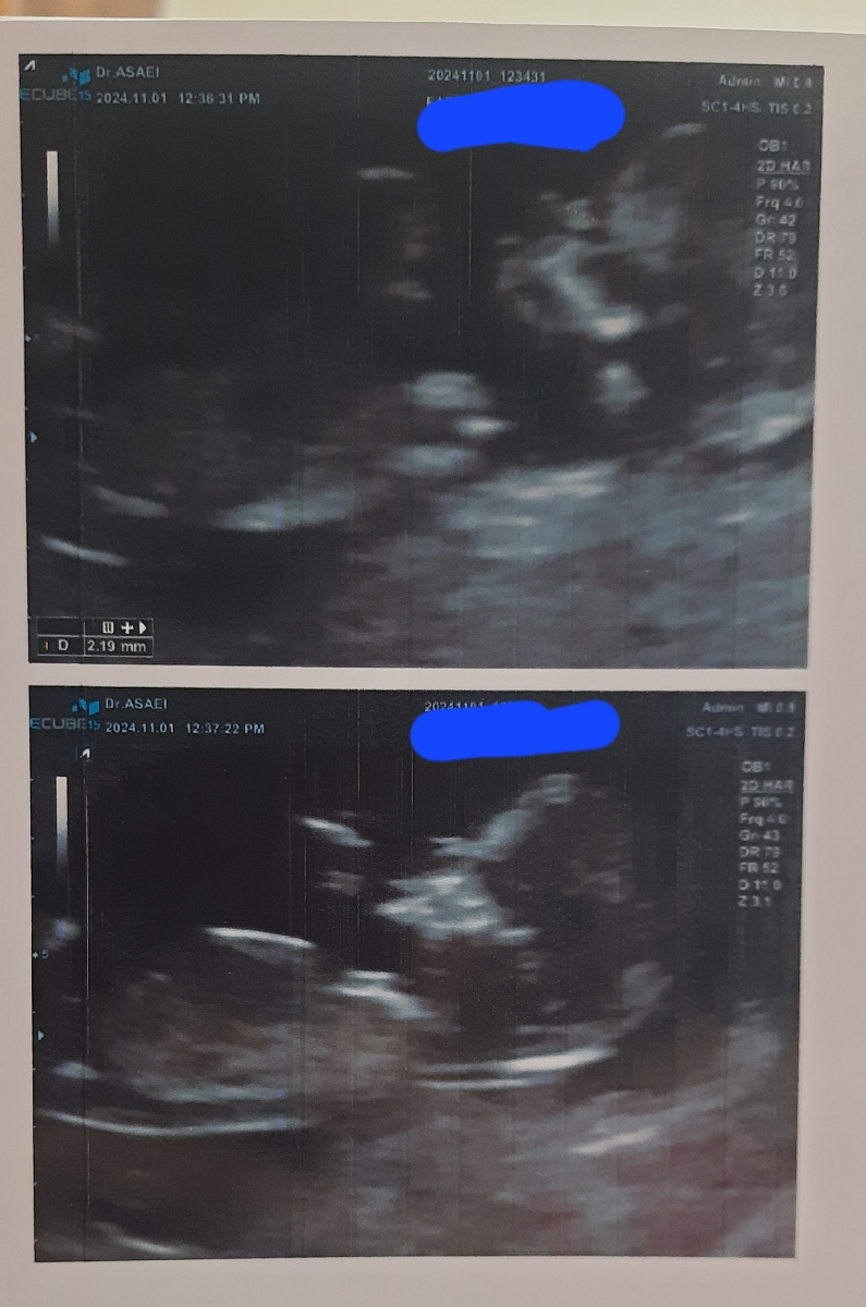 تعیین جنسیت جنین با سونو ان تی تعیین جنسیت جنین با سونو ان تی