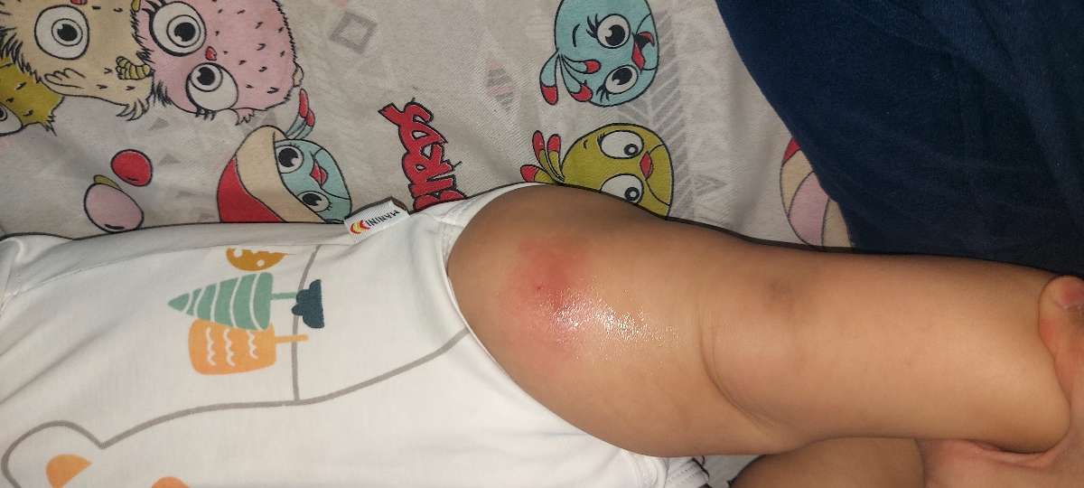 کبودی پای نوزاد بعد واکسن کبودی پای نوزاد بعد واکسن