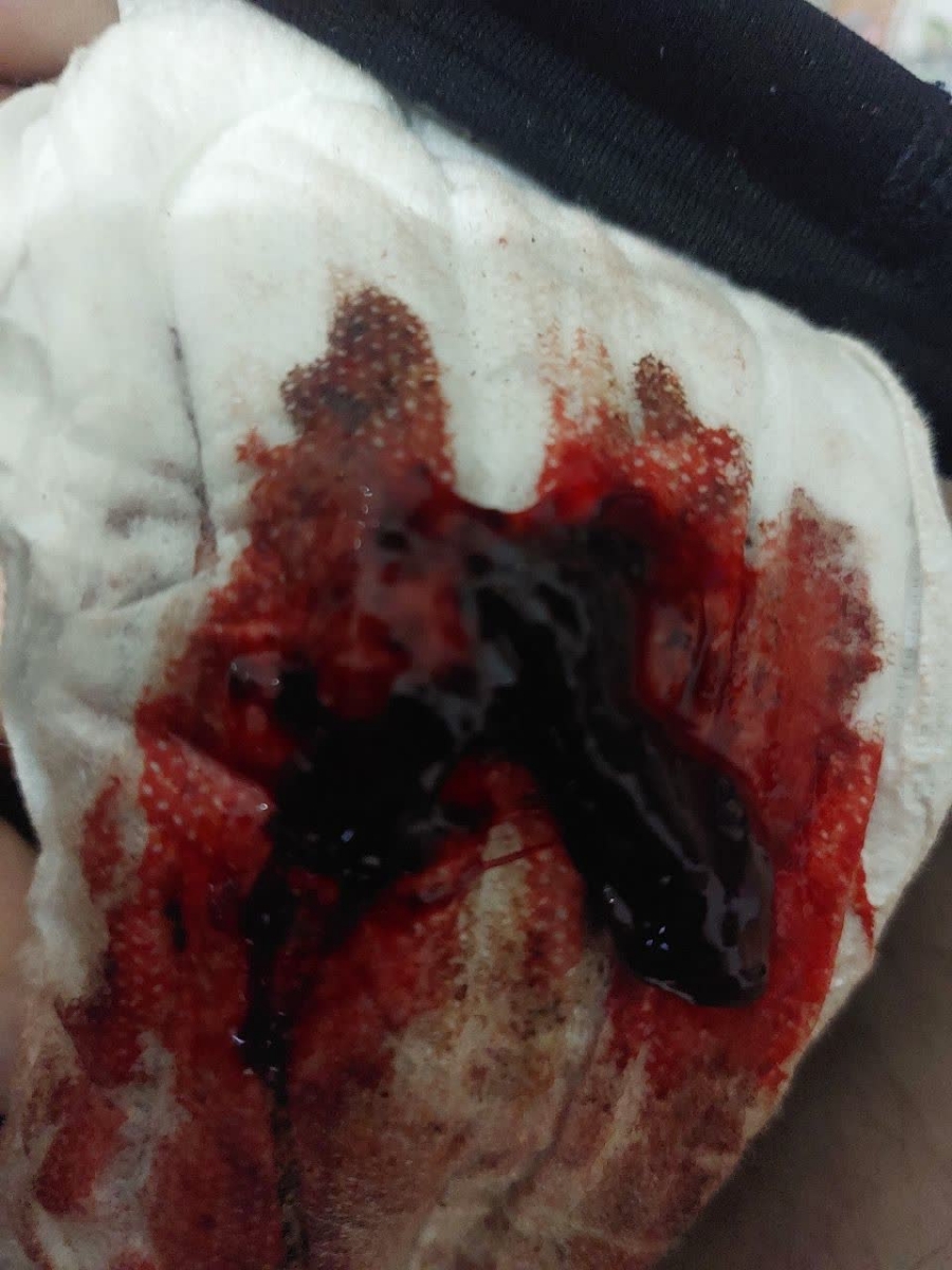 پریودی با دفع لخته های بزرگ همراه با عکس⛔️