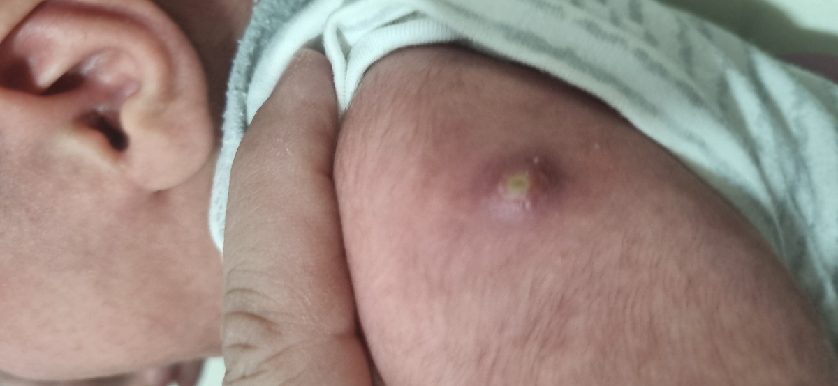 جای واکسن اولیه 