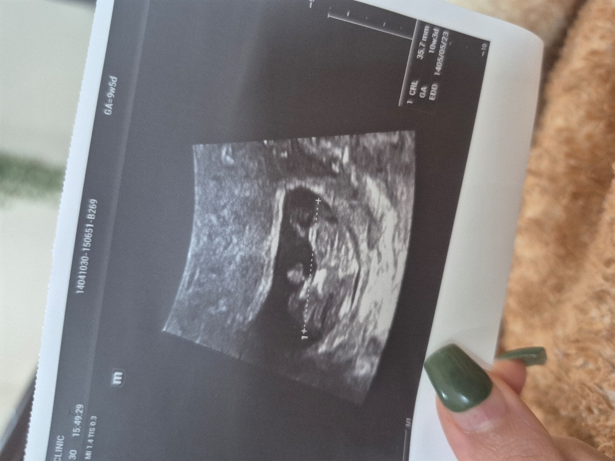 بررسی تصویر سونوگرافی ده هفته