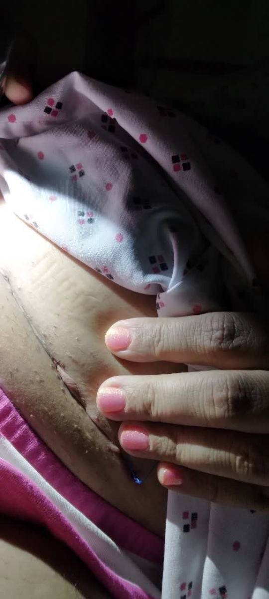 بخیه باز شده یا دوخته نشده