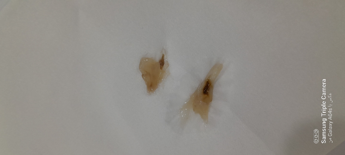 عفونت قارچی دارم و درد وترشحات پنیری عفونت قارچی دارم و درد وترشحات پنیری