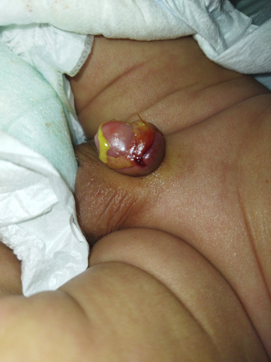 مراقبت بعد از ختنه کردن نوزاد