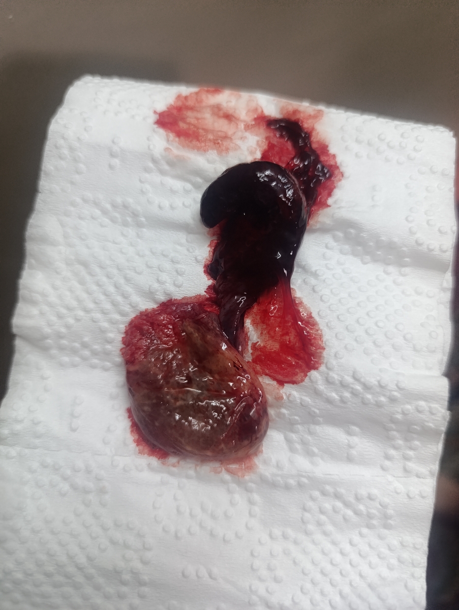 سقط آغازی برای مادر شدن 👩‍🍼👼🫃