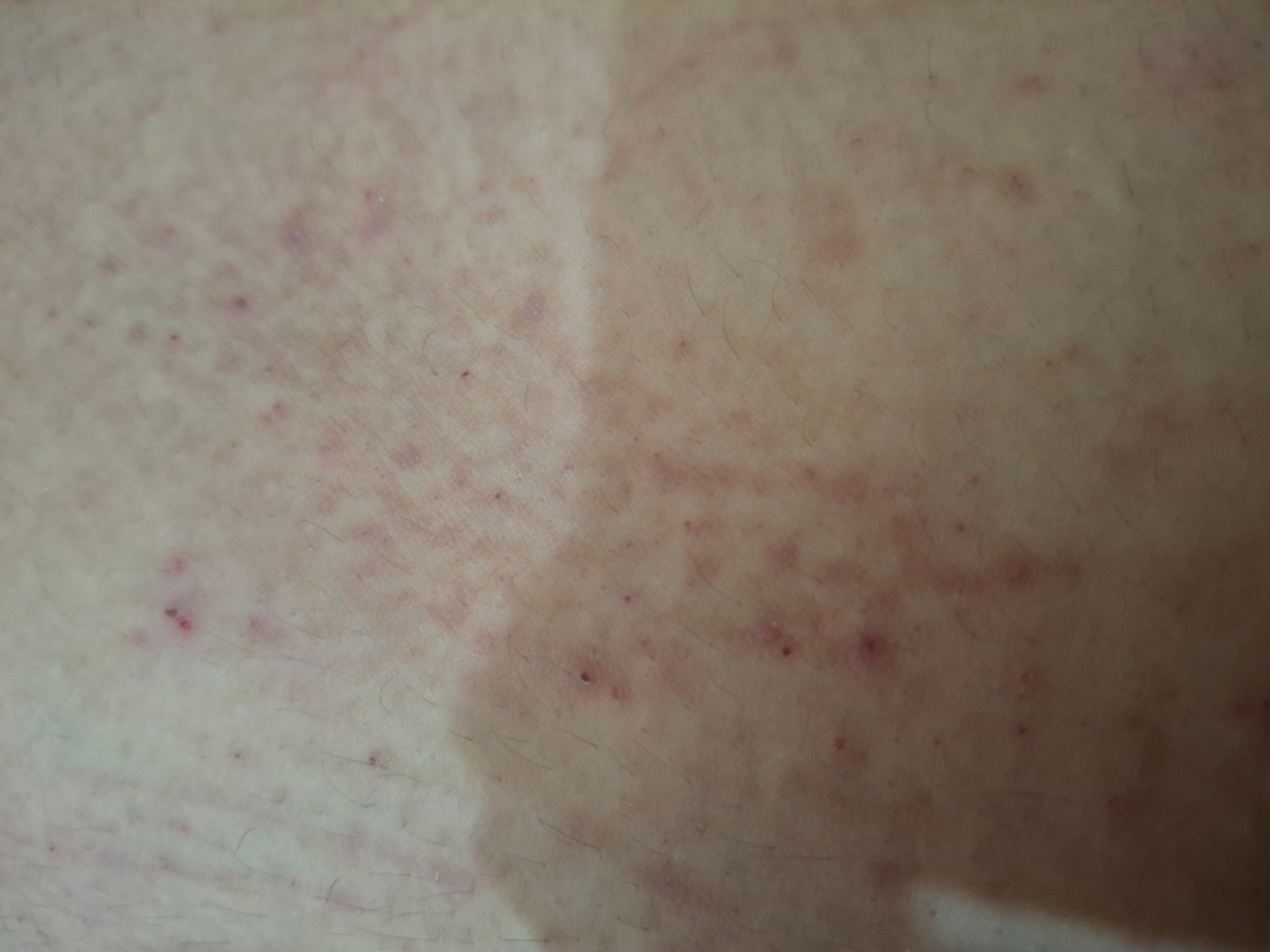 جوش و زخم شدن بدن و خارش