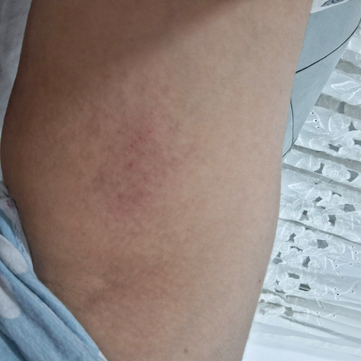 جوش و زخم شدن بدن و خارش