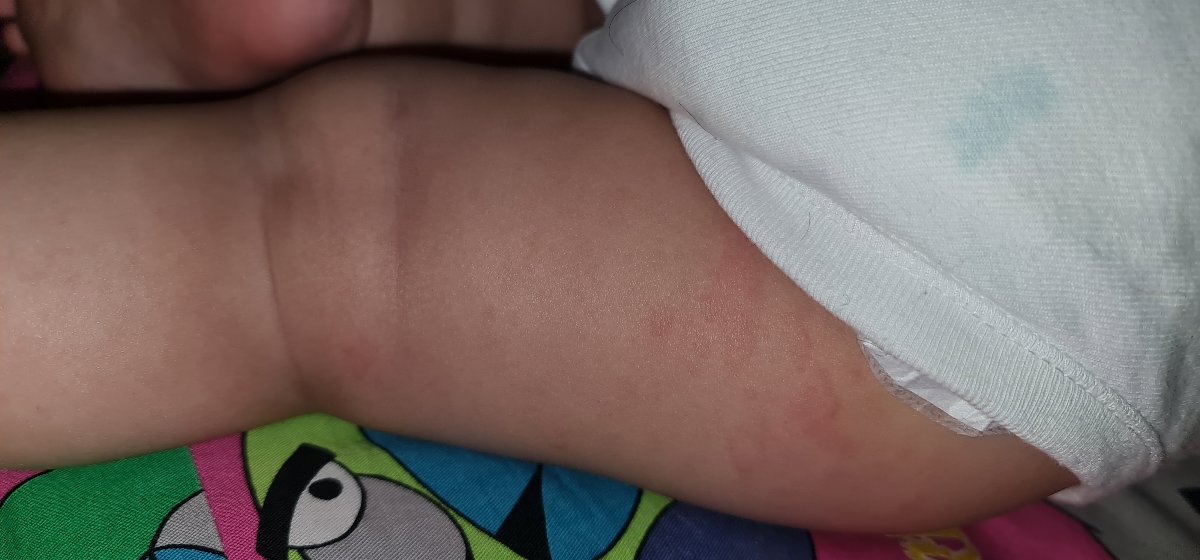 دانه های پوستی متعدد روی بدن نوزاد یکساله