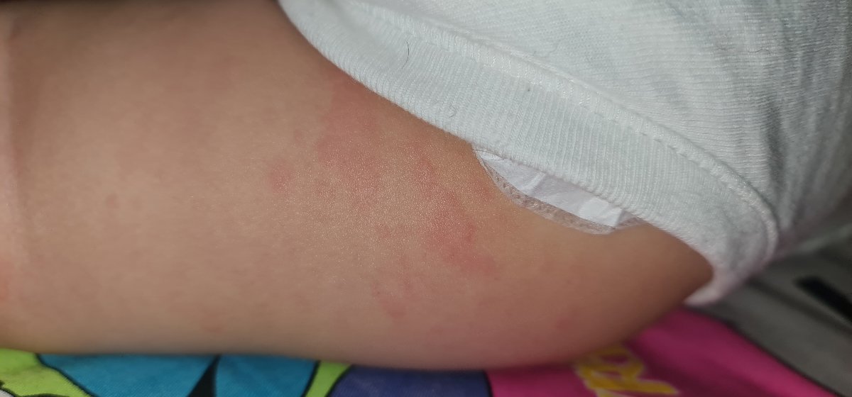 دانه های پوستی متعدد روی بدن نوزاد یکساله