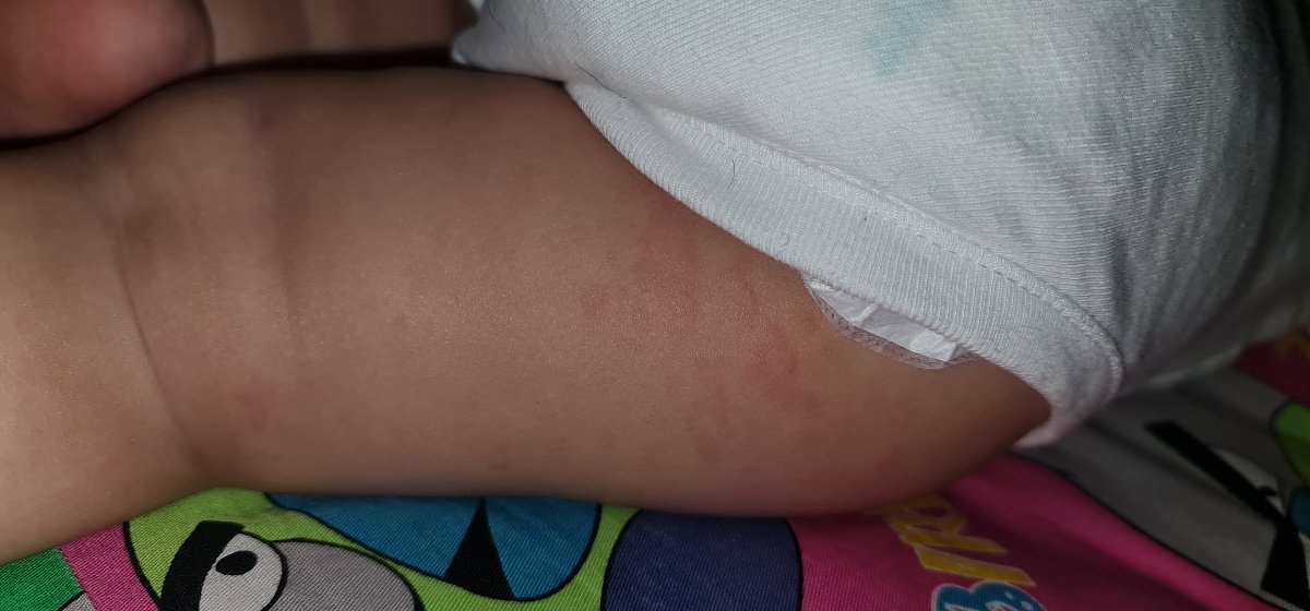 دانه های پوستی متعدد روی بدن نوزاد یکساله