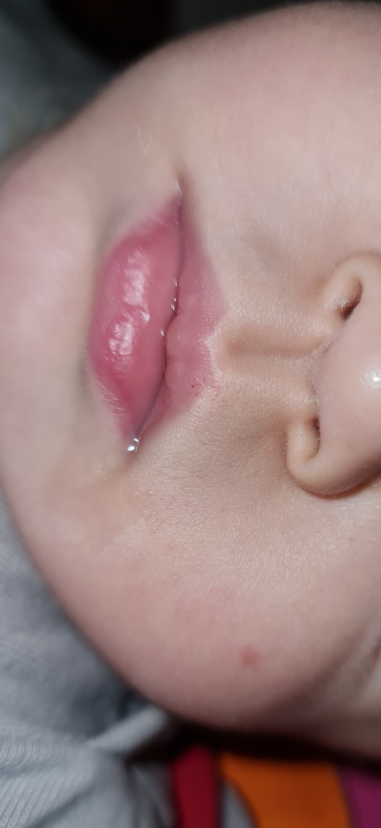 ببخشید اینم میشه بگین تبخاله یا نه؟گوشه بالایی سمت راست لبش