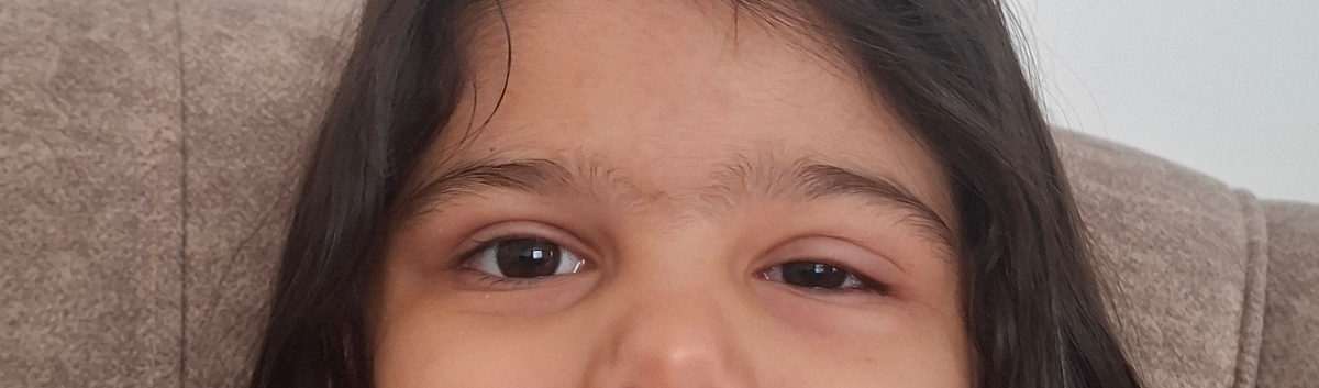 ورم کردن چشم کودک ۴ ساله