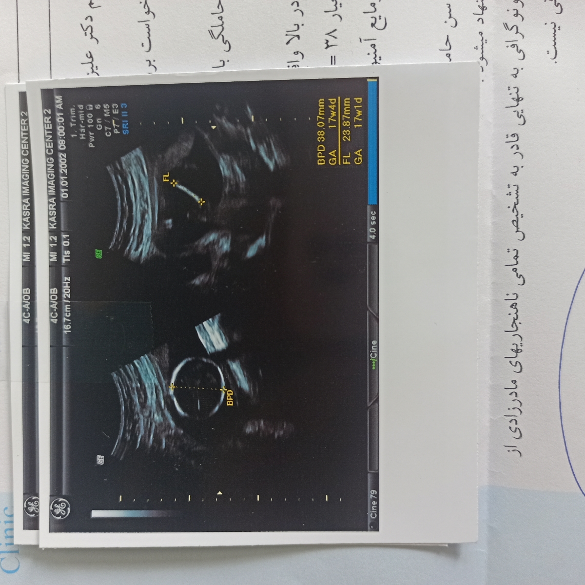 اندازه گیری طول سرویکس