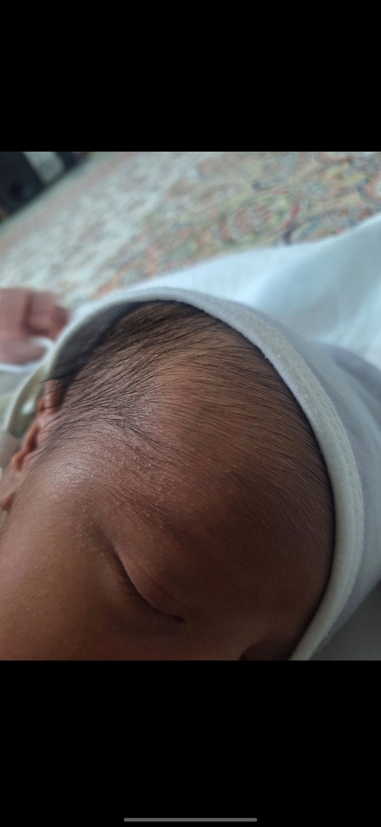 جوش های ریز روی صورت نوزاد