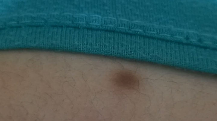 خال قهوه ای بزرگ روی کتف