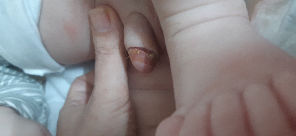 ختنه سنتی و عکس