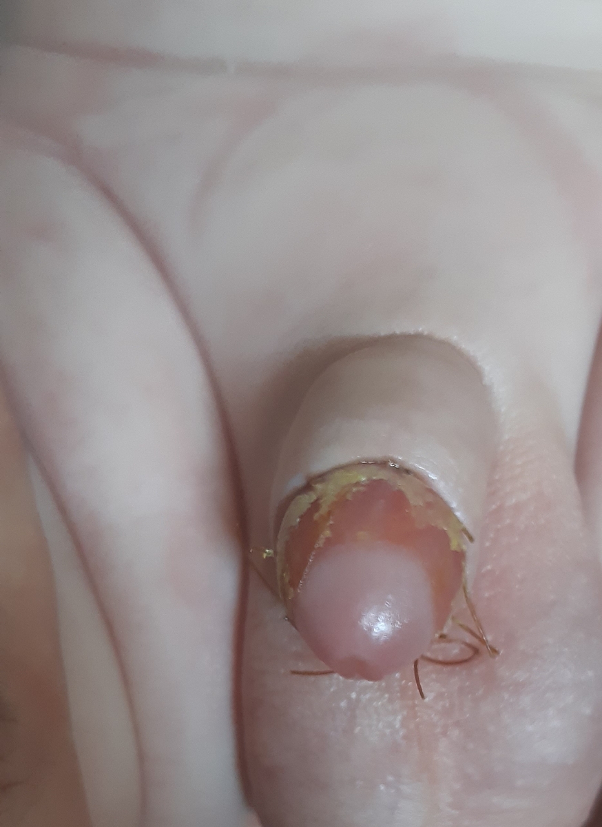 ختنه سنتی و عکس