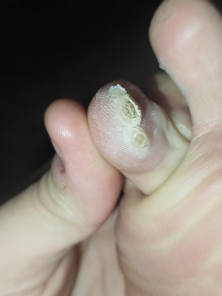 از بین رفتن میخچه