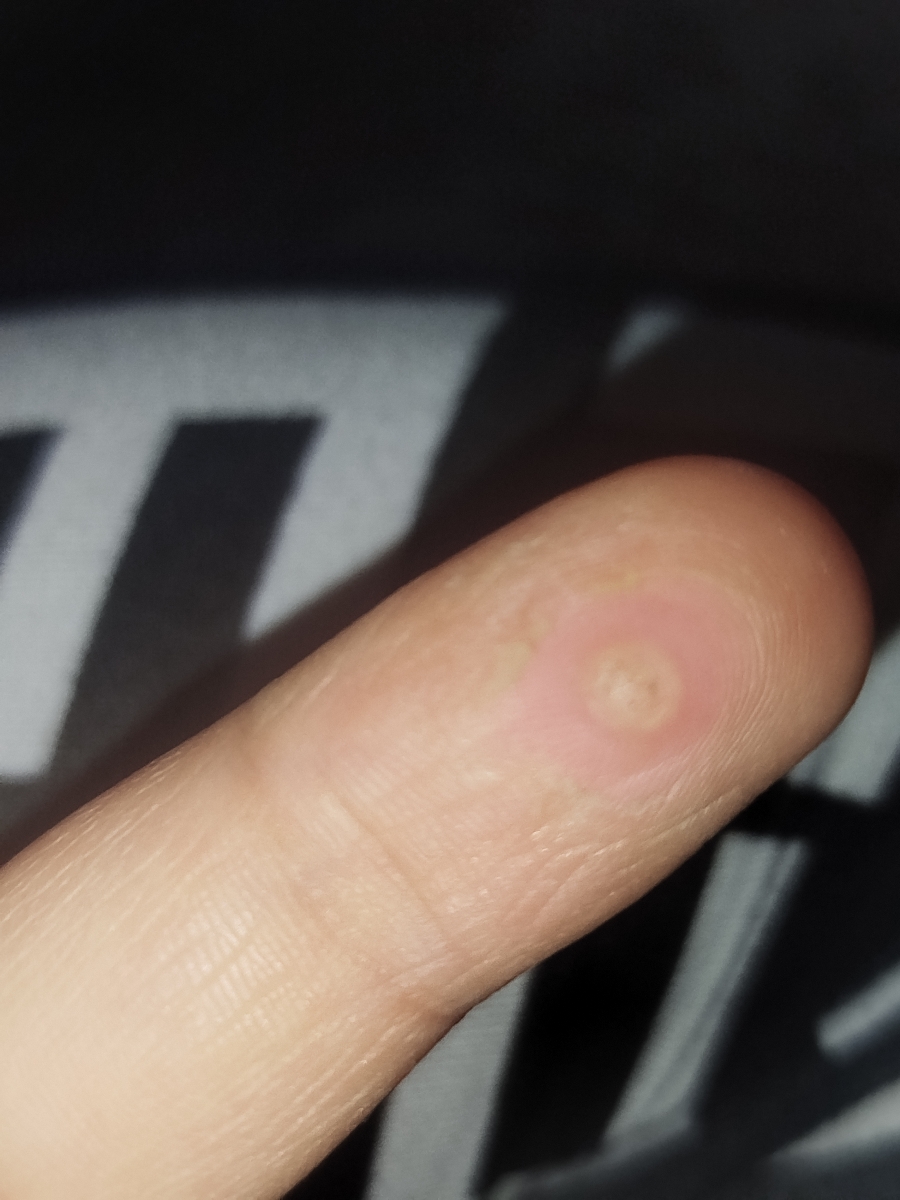 از بین رفتن میخچه