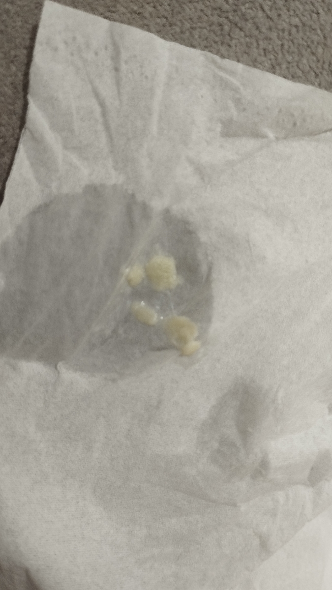 ترشحات پنیری در بارداری