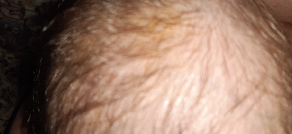 زرد بودن پوست سر نوزاد