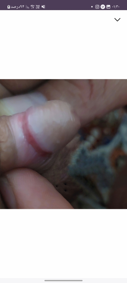 اینجا روز دوم بعد از زدن هیدروکورتیزون هست ببین چه بهتر شده انگار دیگه دور قرمزیه خشک‌تر شده چسبنده نیست