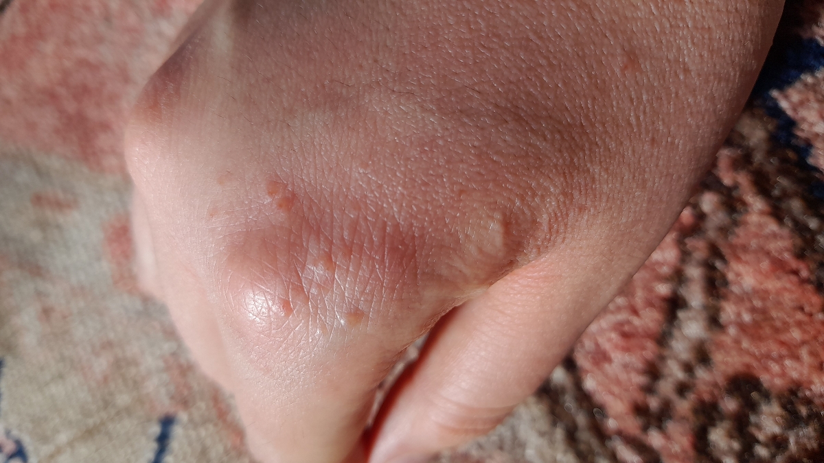 حساسیت پوستی و خارش دست هام