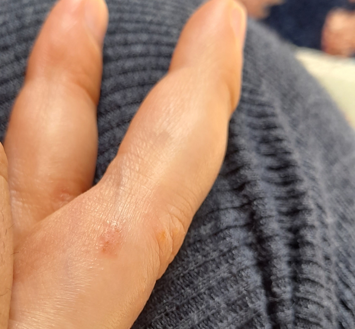 حساسیت پوستی و خارش دست هام