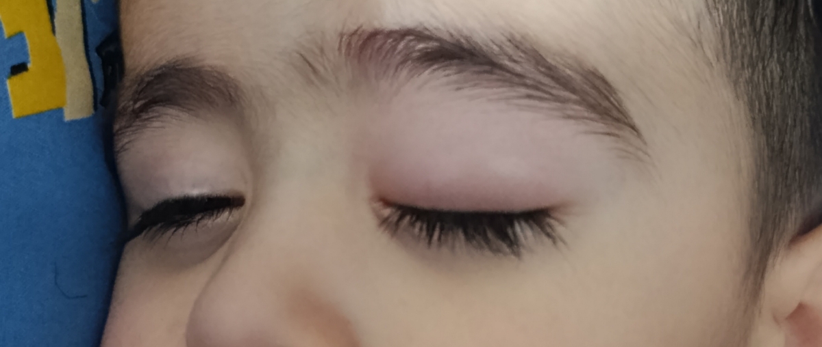 ورم چشم کودک 2ساله