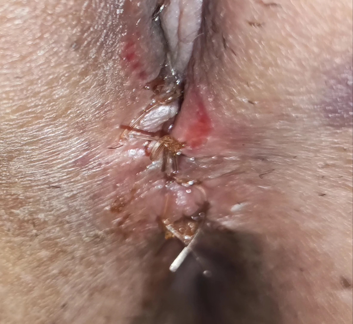 عمل پرینو پلاستی انجام دادم...عکس❌