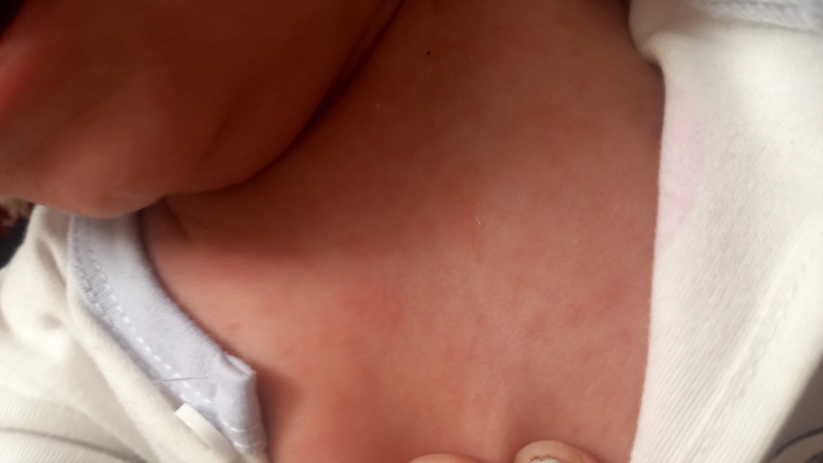 دون قرمز روی صورت و بدن نوزاد دون قرمز روی صورت و بدن نوزاد